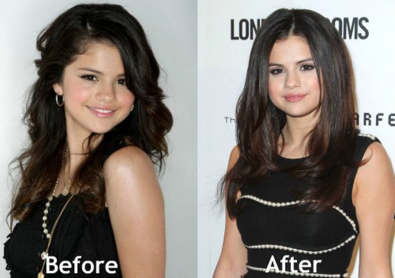 Juicy Facts About the Selena Gomez’s Plastic Surgery Claims – Japan